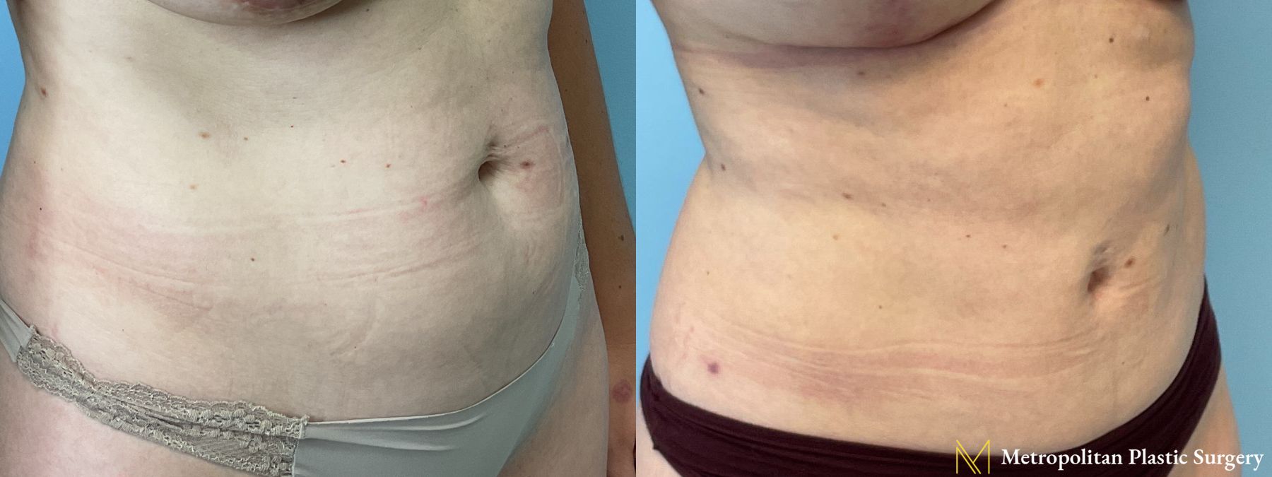 Before and after Liposuction case 41384 - Angle 2