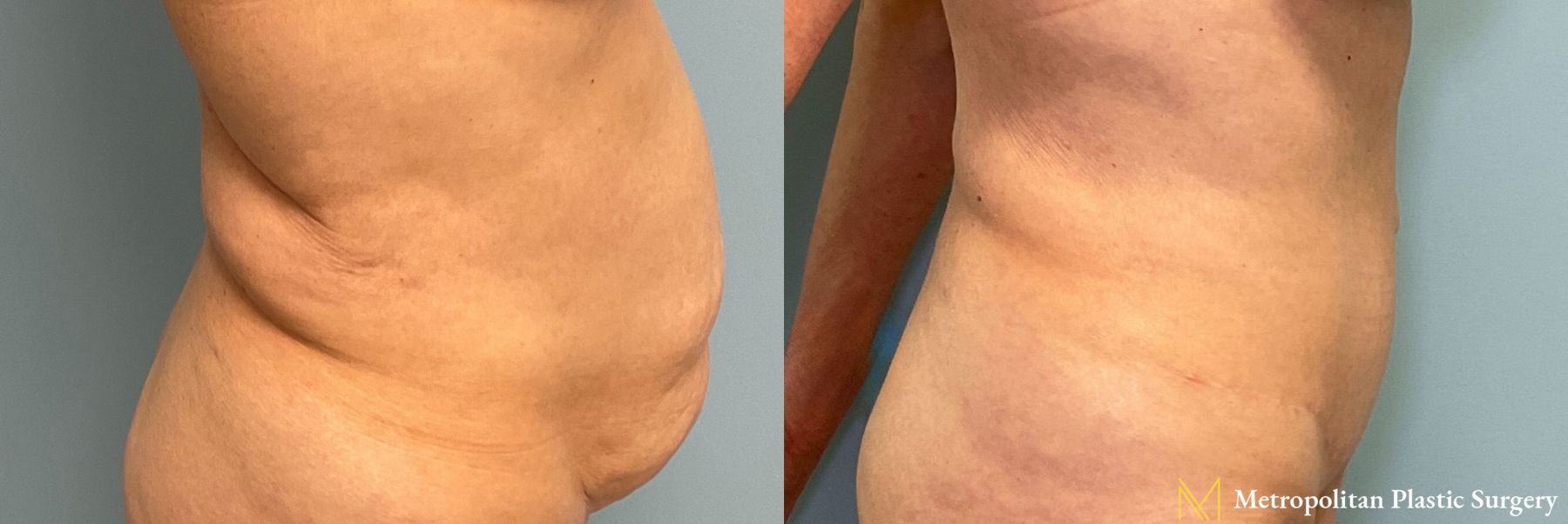 Before and after Tummy Tuck case 26061 - Angle 3