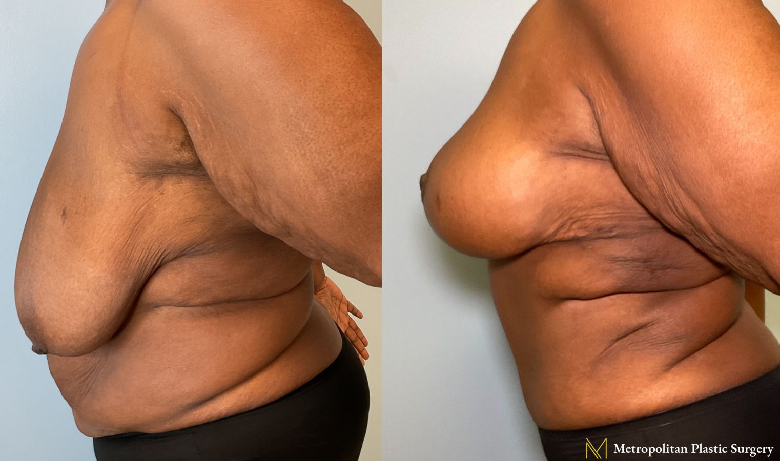Mommy Makeover performed by Dr. Julia Spears - Angle 3