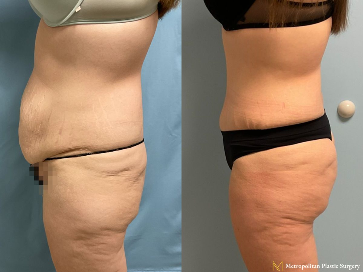 Before and after Mommy Makeover case 21779 - Angle 3