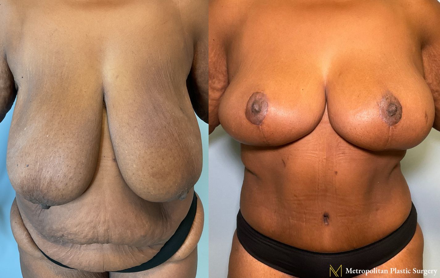 Mommy Makeover performed by Dr. Julia Spears - Angle 2