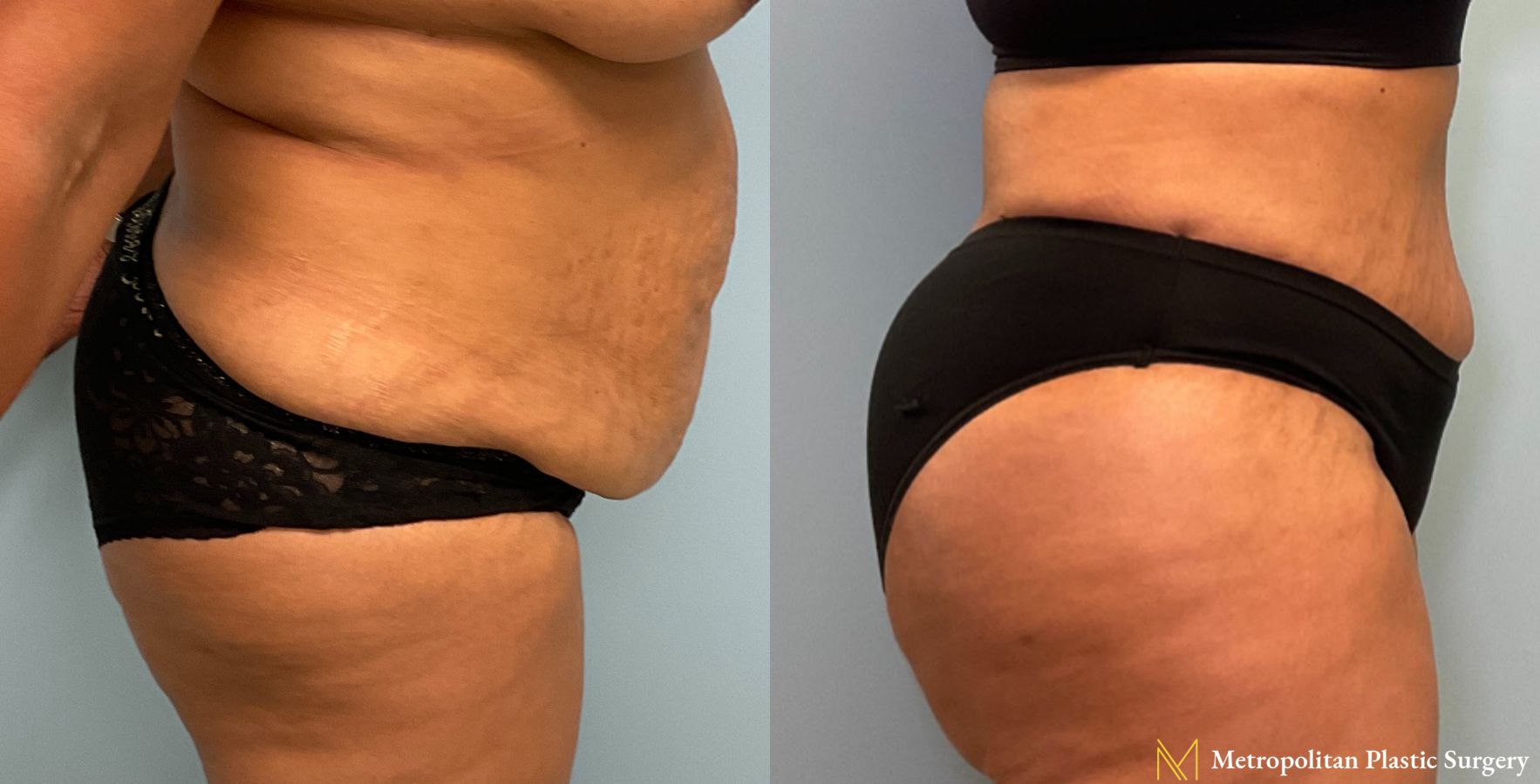 Before and after Tummy Tuck case 23982 - Angle 2
