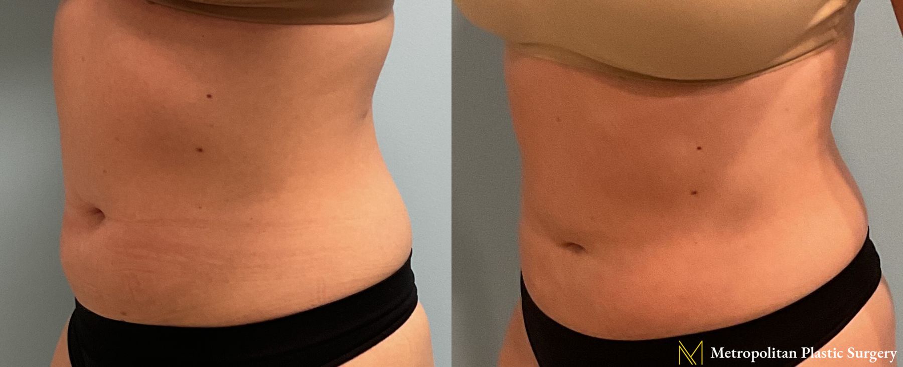 Before and after Liposuction case 23987 - Angle 3