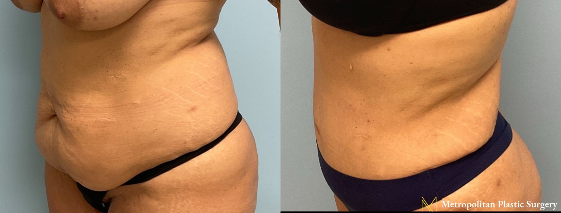 Let liposuction from board certified Julia Spears MD take care of stubborn fat. - Angle 4