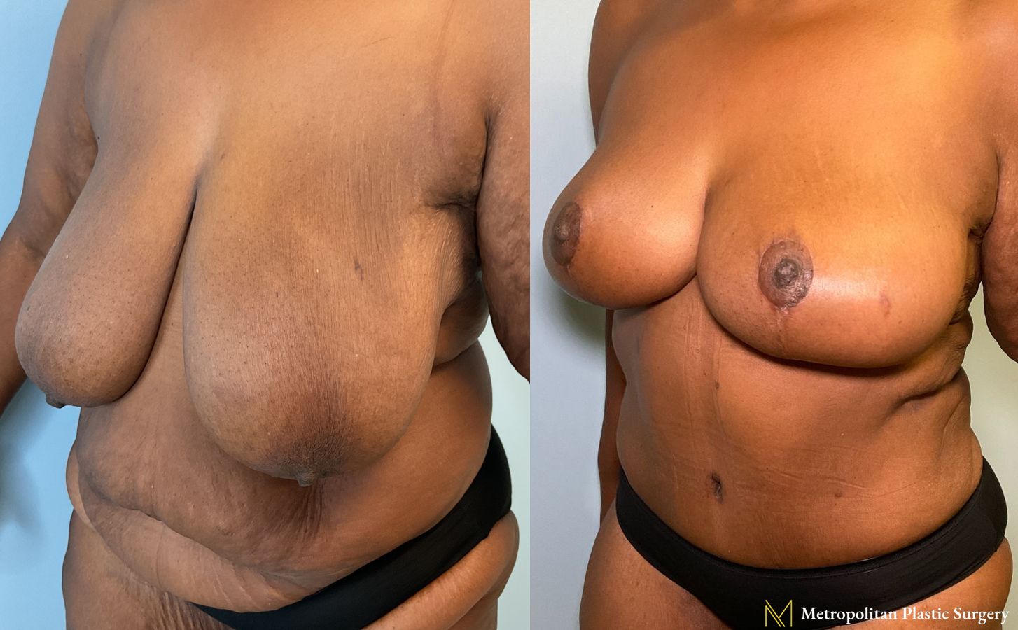 Mommy Makeover performed by Dr. Julia Spears