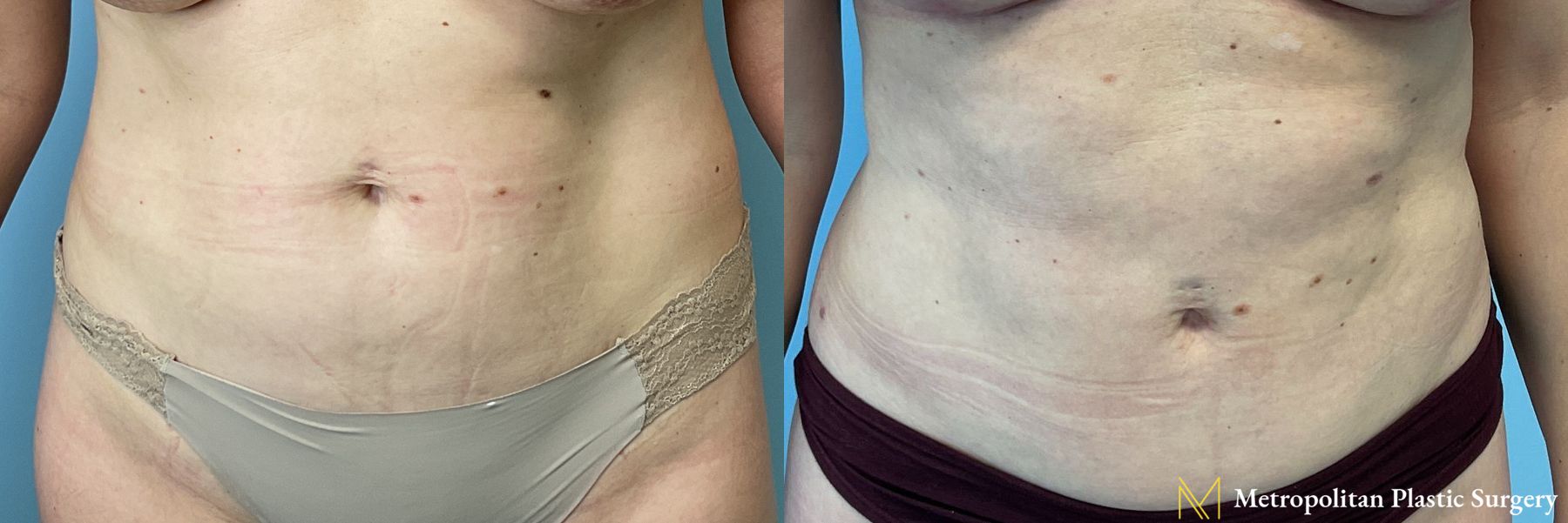 Before and after Liposuction case 41384