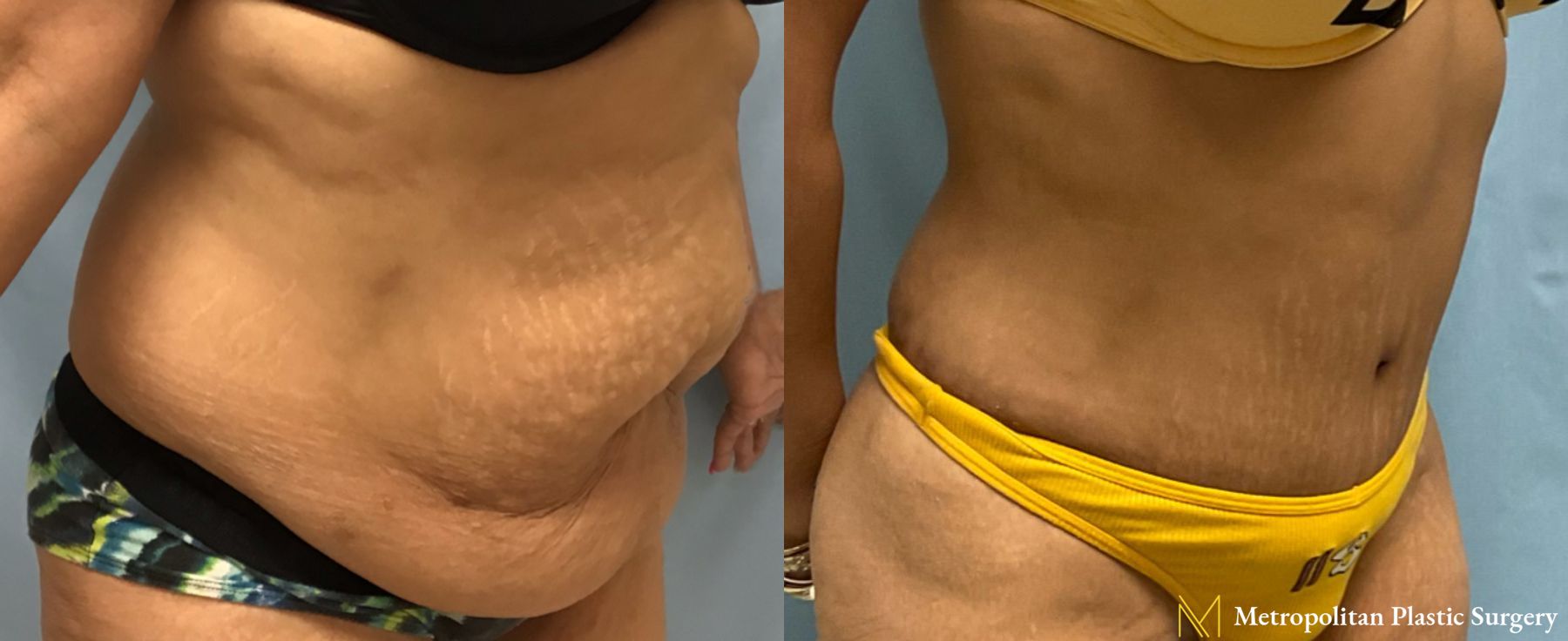 Before and after Liposuction case 23856 - Angle 2
