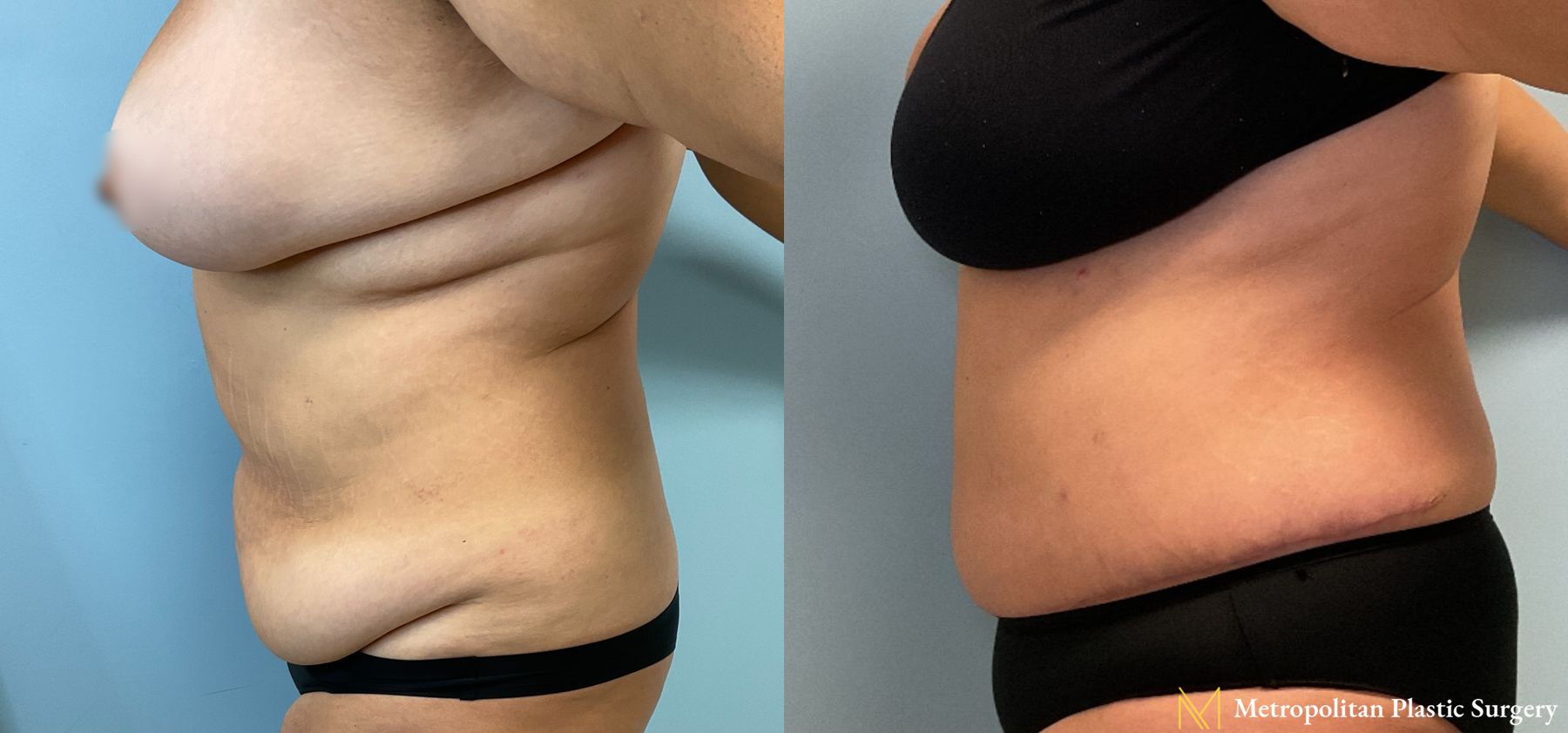 Before and after Tummy Tuck case 26092 - Angle 2