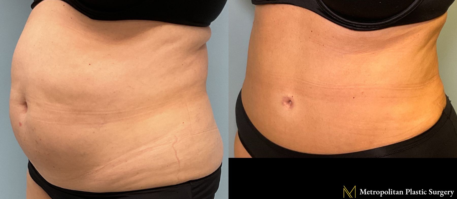 Tummy Tuck performed by Dr. Julia Spears - Angle 2