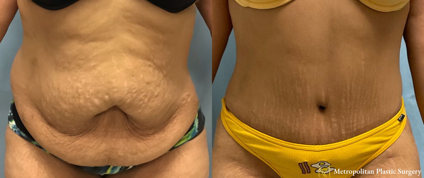 Before and after Liposuction case 23856