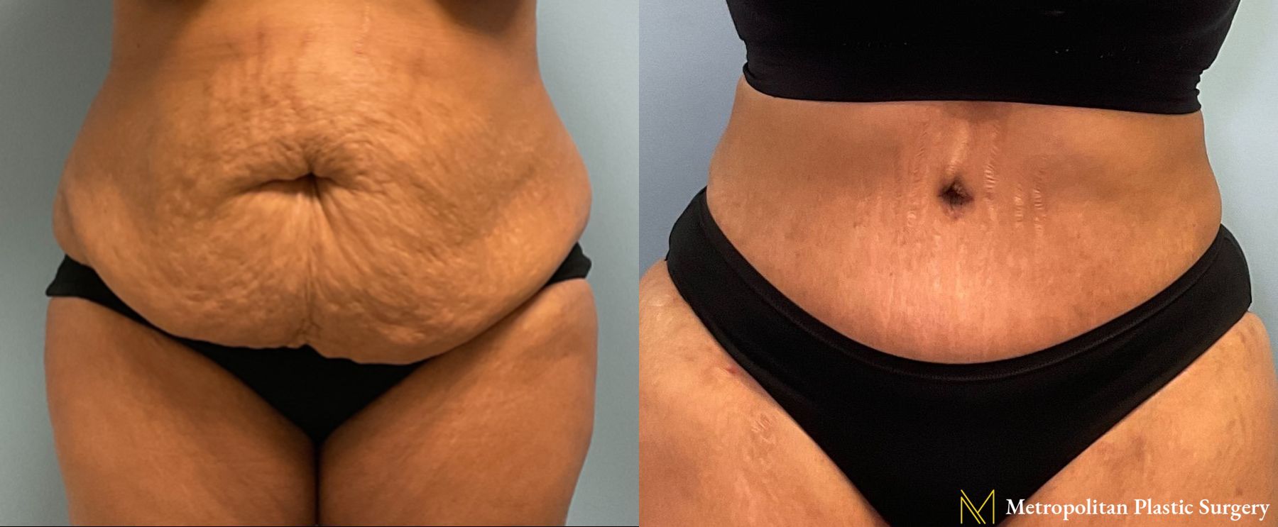 Before and after Tummy Tuck case 23982