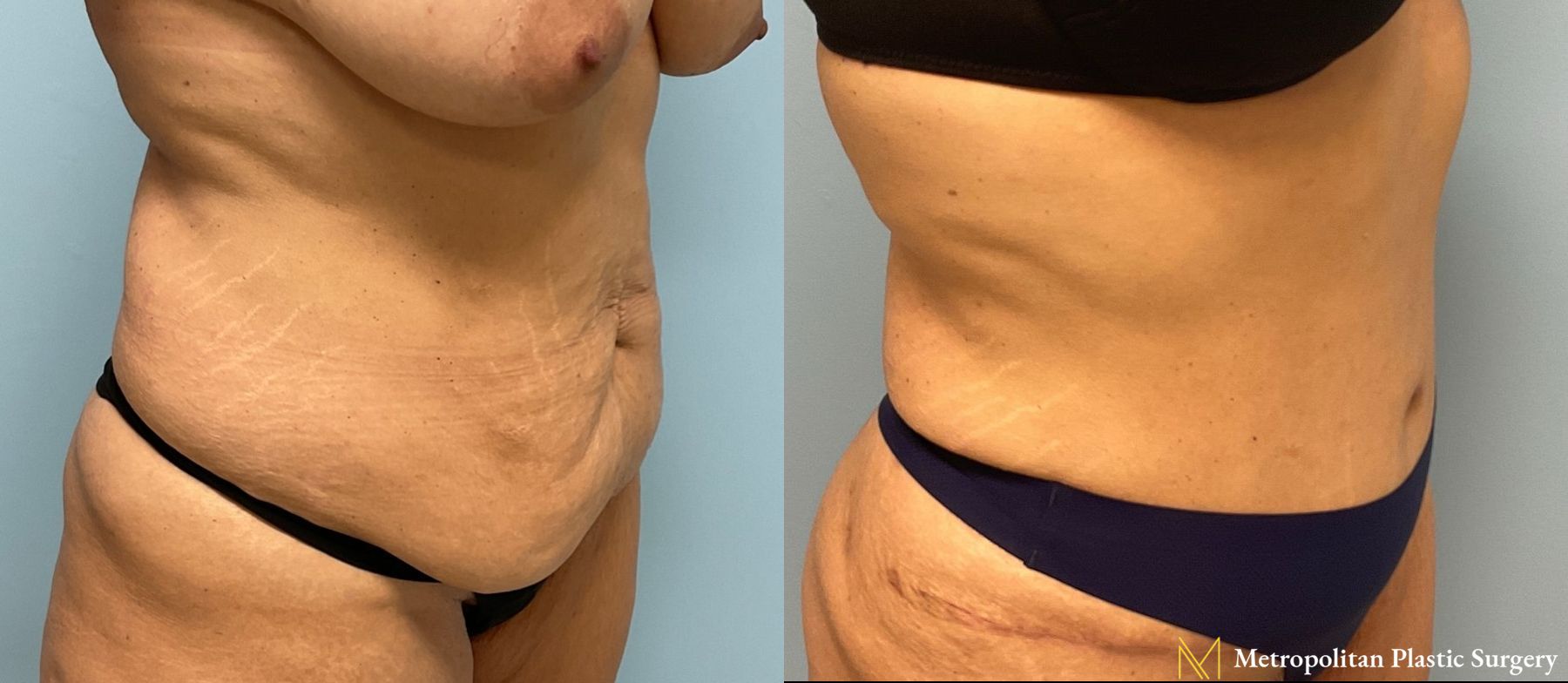Let liposuction from board certified Julia Spears MD take care of stubborn fat. - Angle 3