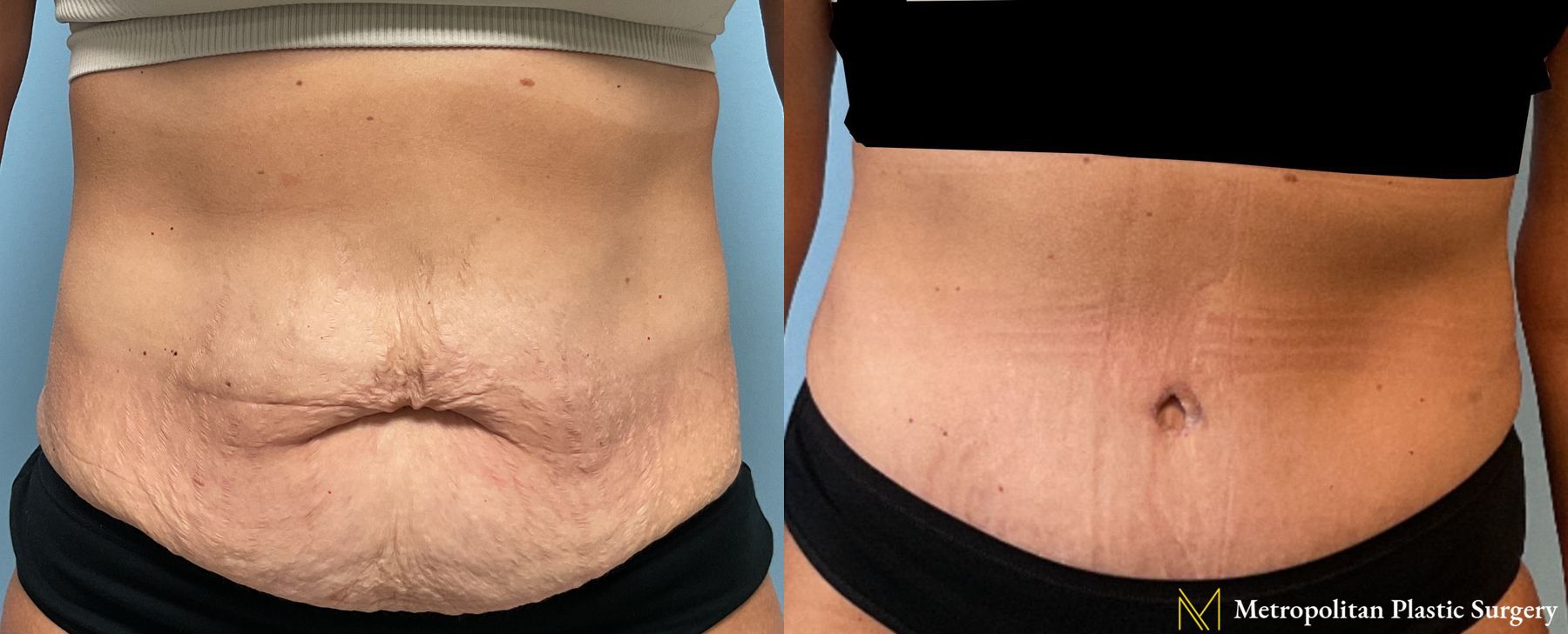 Before and after Tummy Tuck case 24004