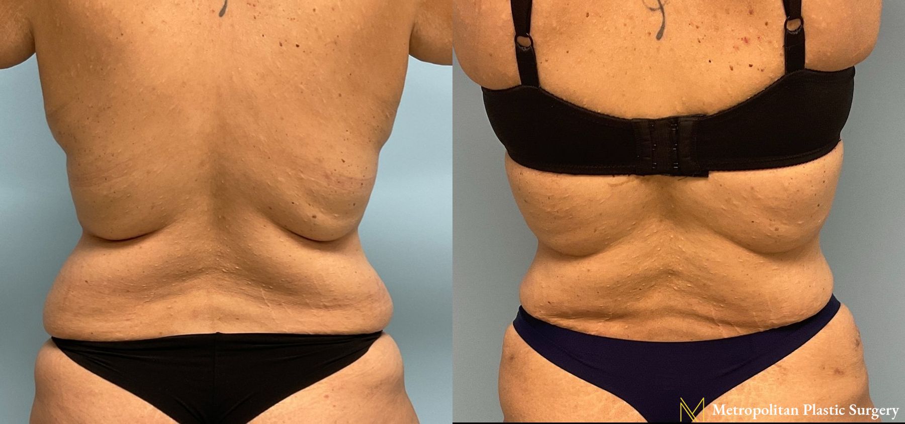 Let liposuction from board certified Julia Spears MD take care of stubborn fat. - Angle 6