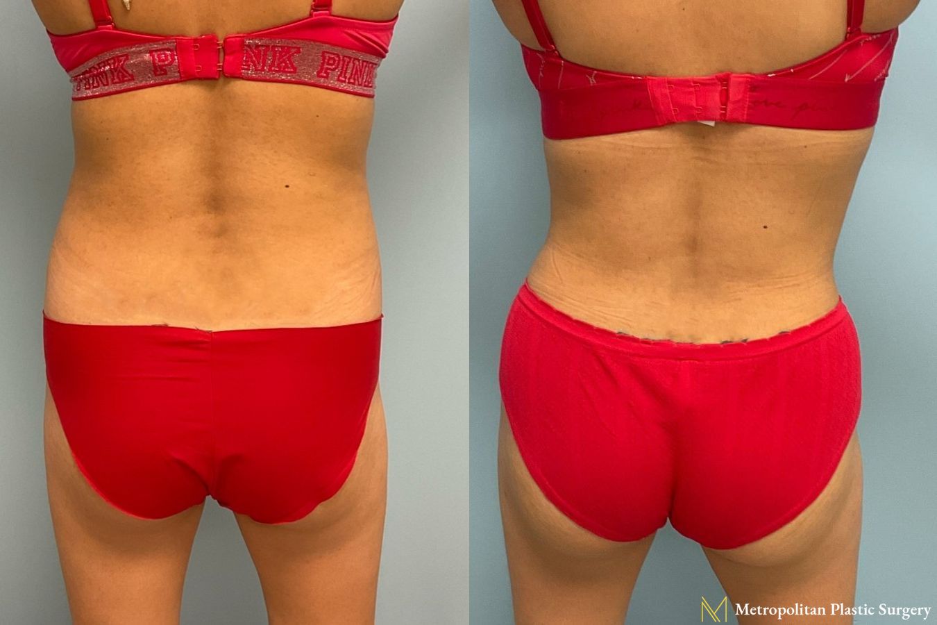 Let liposuction from board certified Julia Spears MD take care of stubborn fat. - Angle 6
