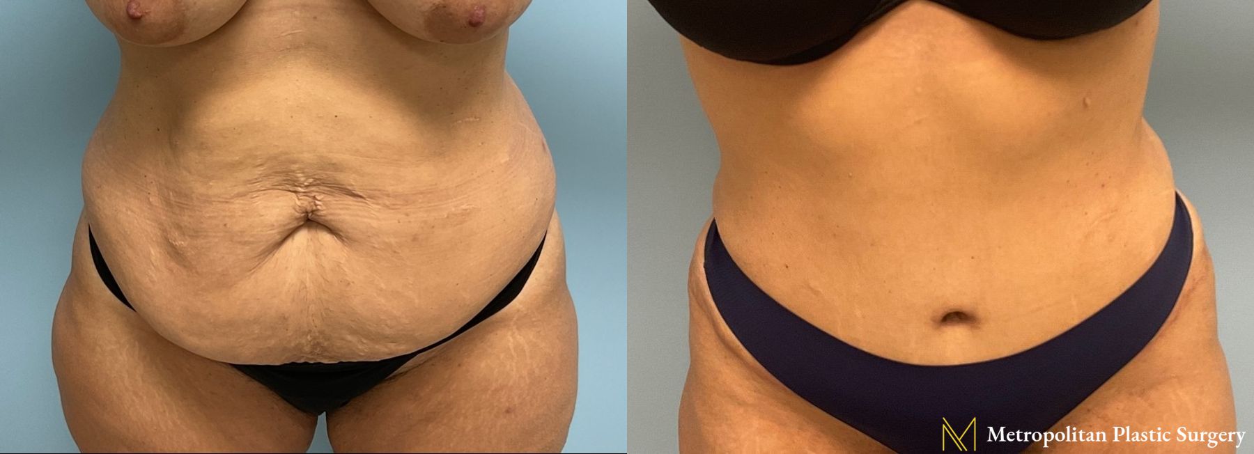 Let liposuction from board certified Julia Spears MD take care of stubborn fat.