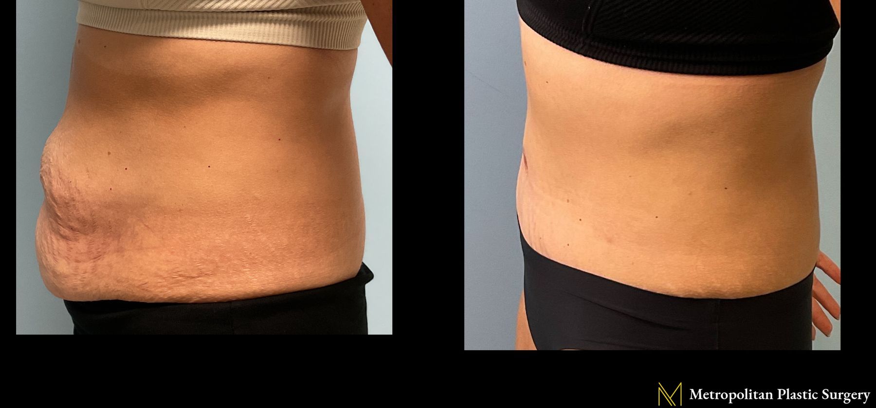 Before and after Tummy Tuck case 24004 - Angle 2