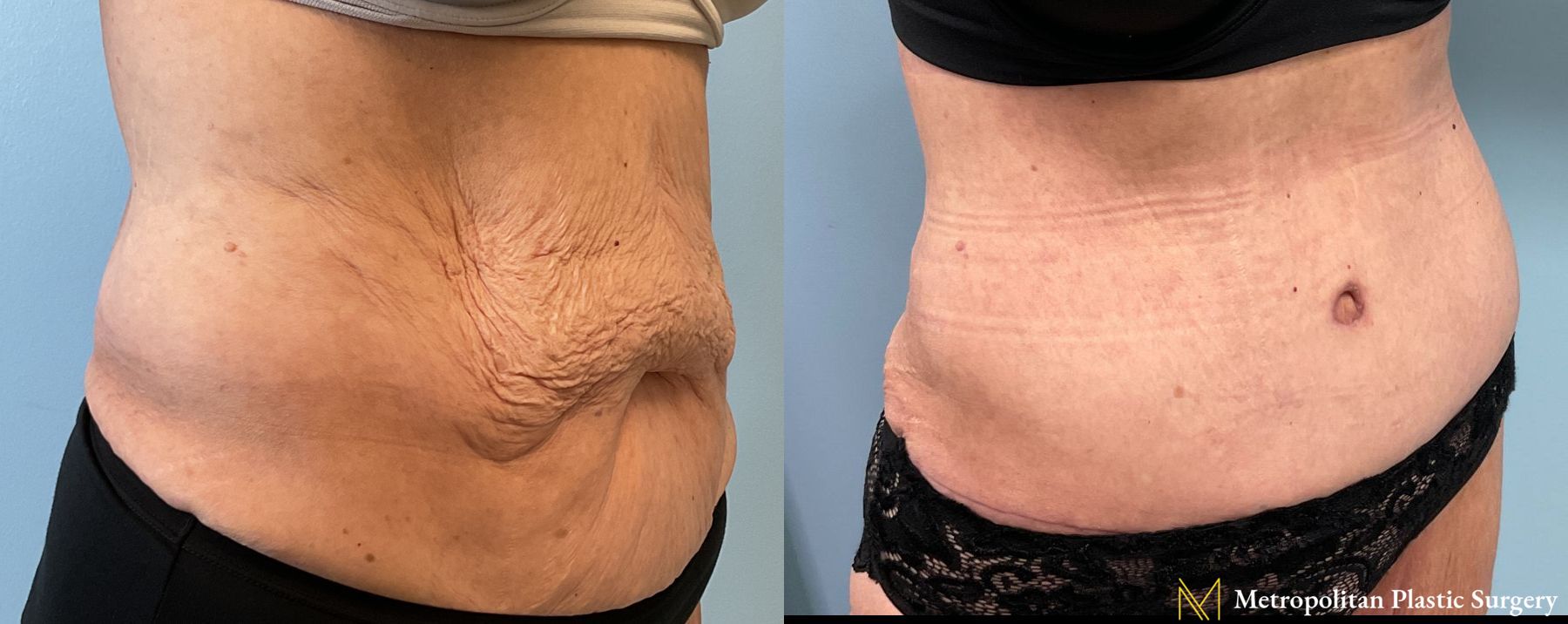 Before and after Fat Grafting case 26062 - Angle 2