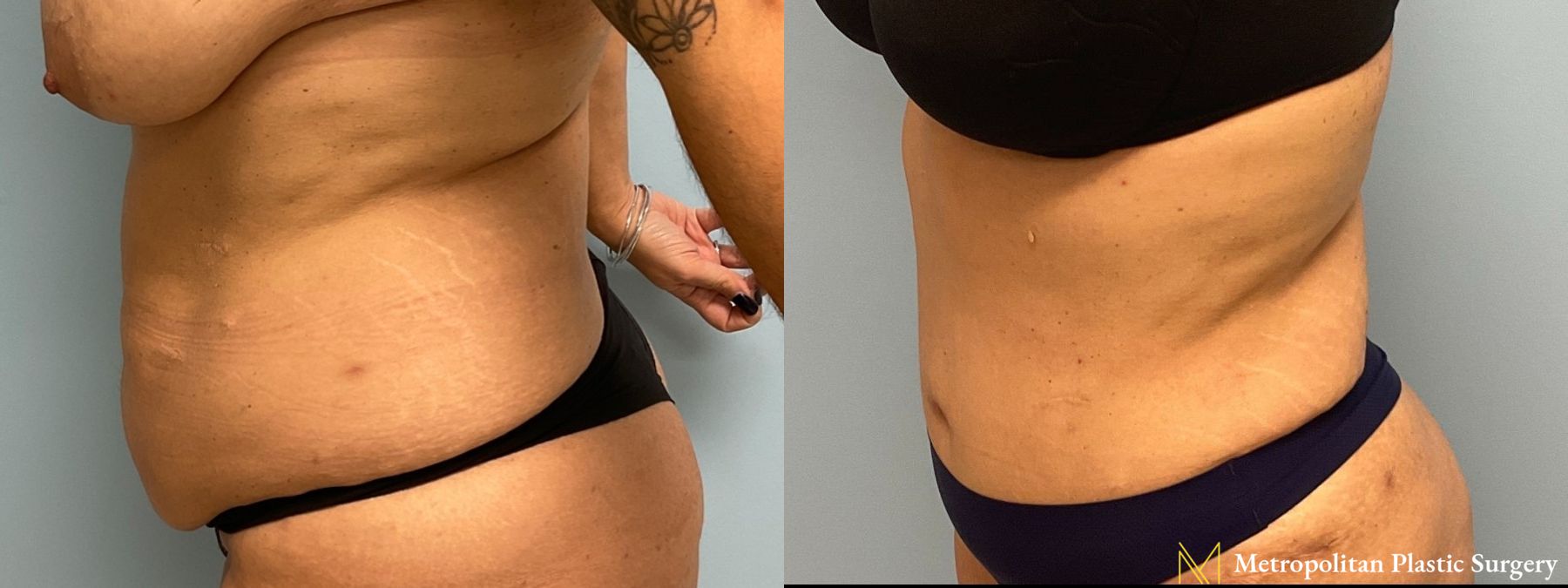 Let liposuction from board certified Julia Spears MD take care of stubborn fat. - Angle 5