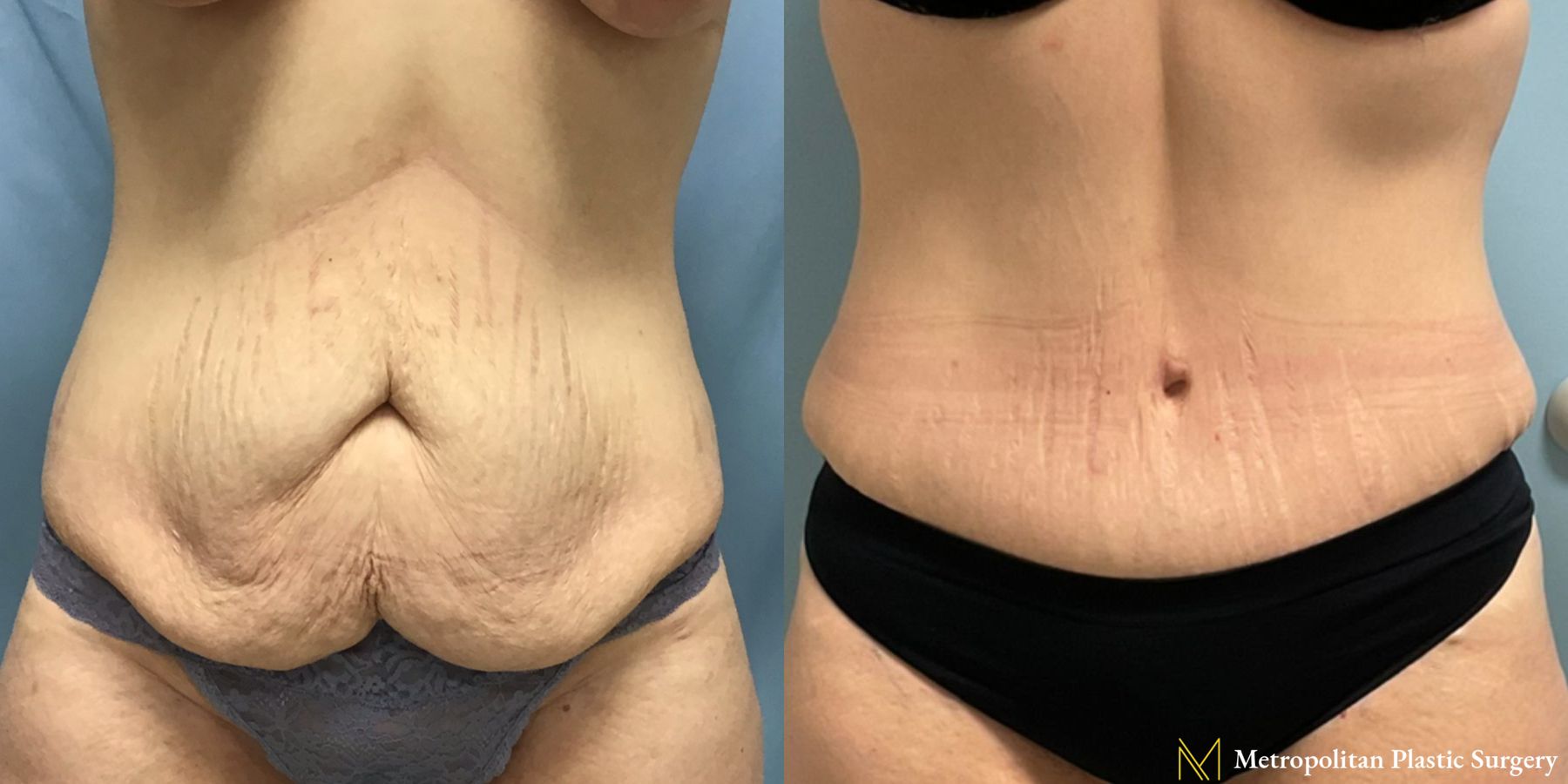 Before and after Mommy Makeover case 21779