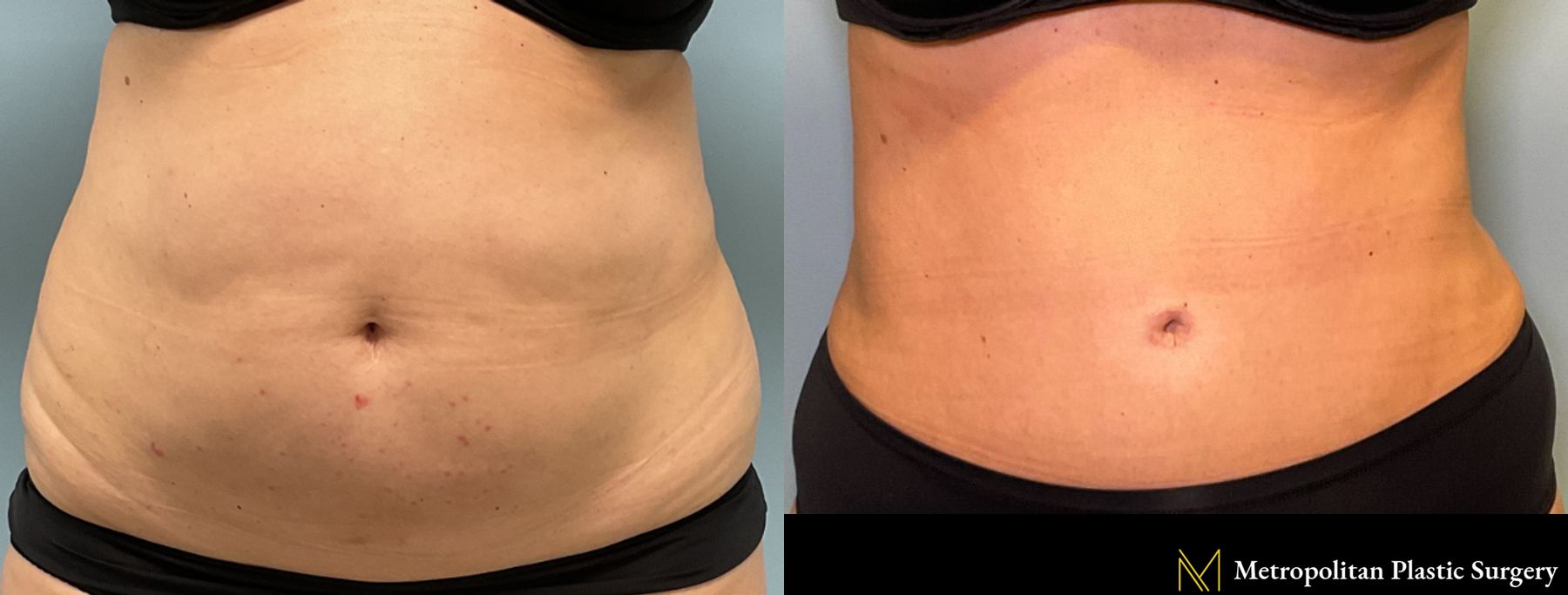 Tummy Tuck performed by Dr. Julia Spears