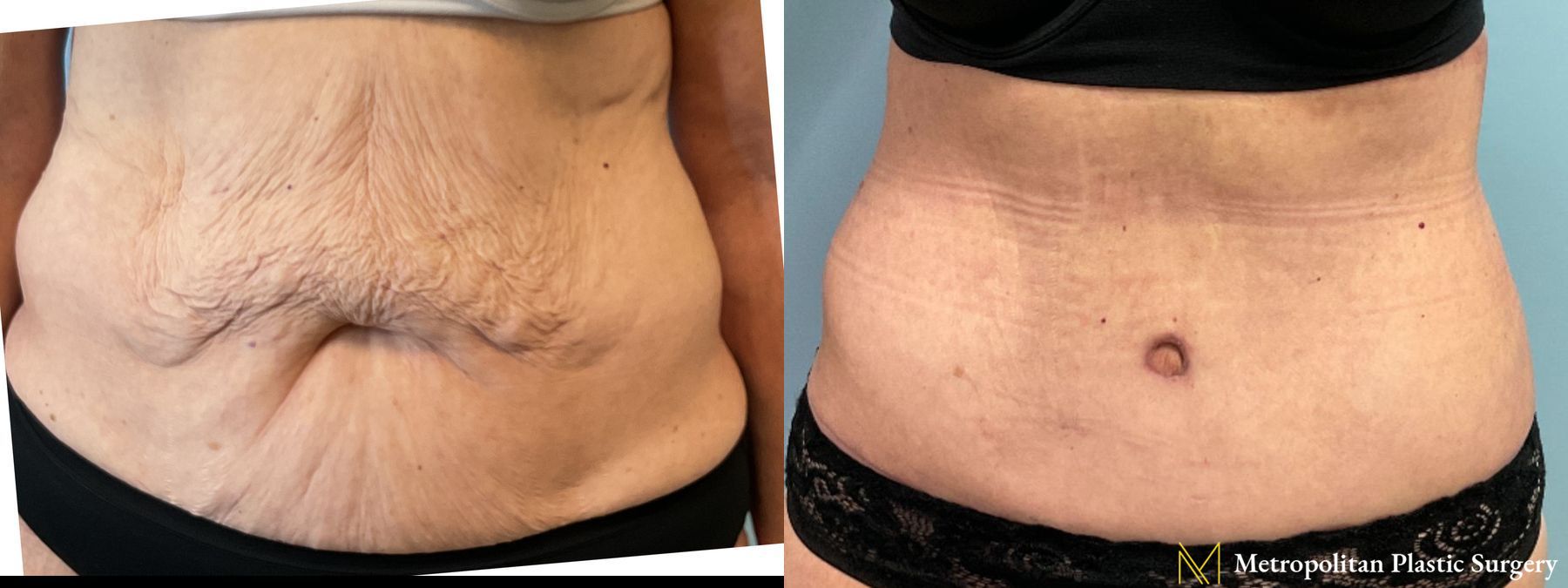 Before and after Fat Grafting case 26062