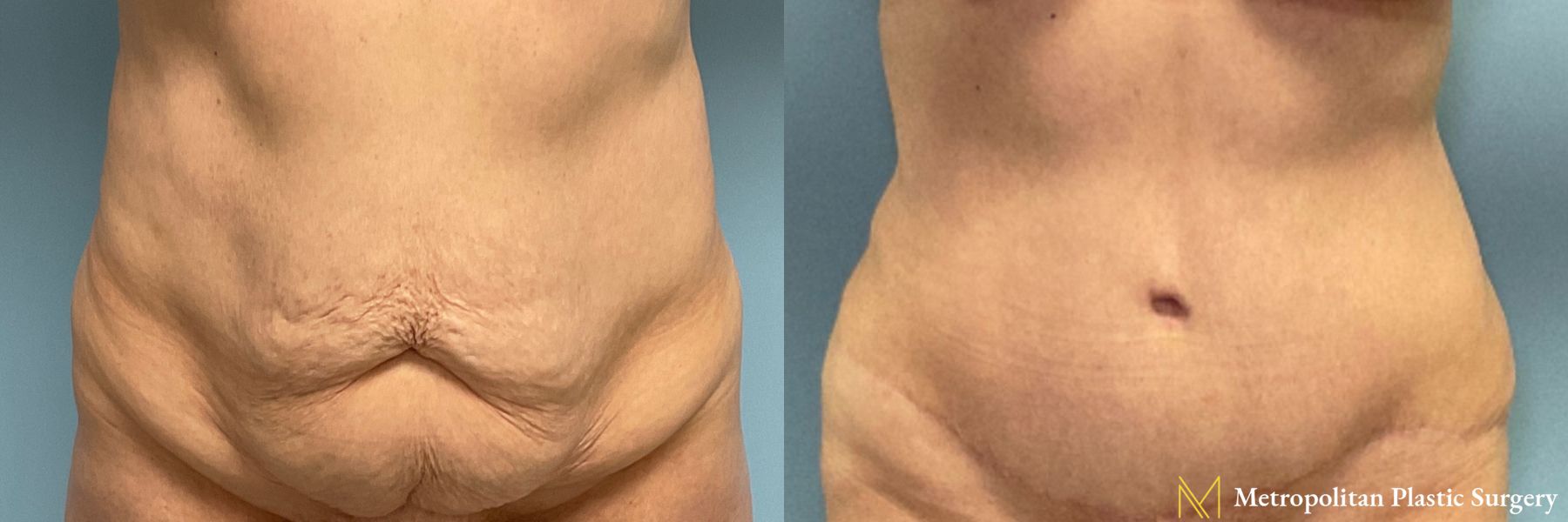 Before and after Tummy Tuck case 26061