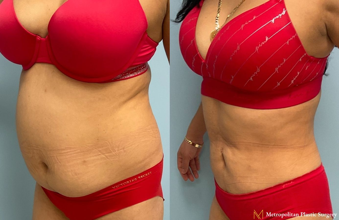 Let liposuction from board certified Julia Spears MD take care of stubborn fat. - Angle 5