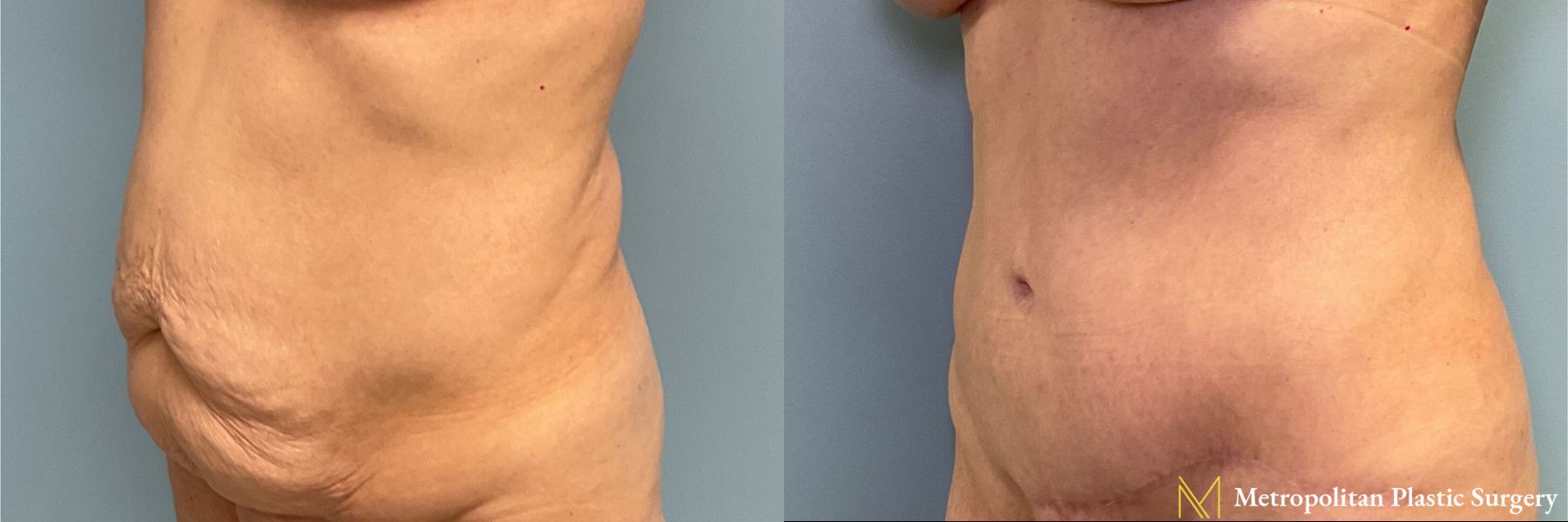 Before and after Tummy Tuck case 26061 - Angle 2