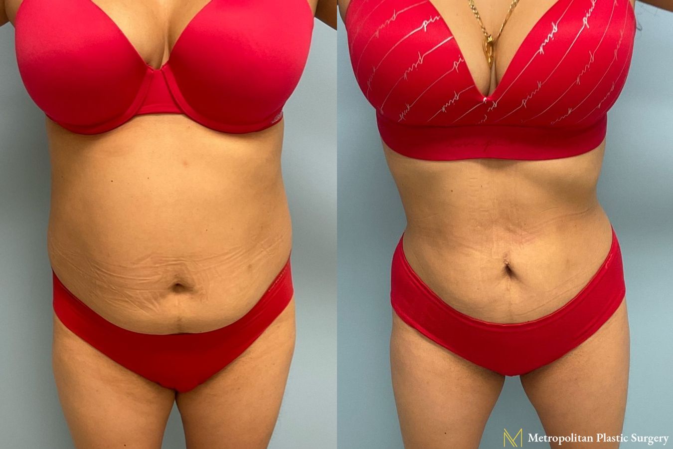 Let liposuction from board certified Julia Spears MD take care of stubborn fat.