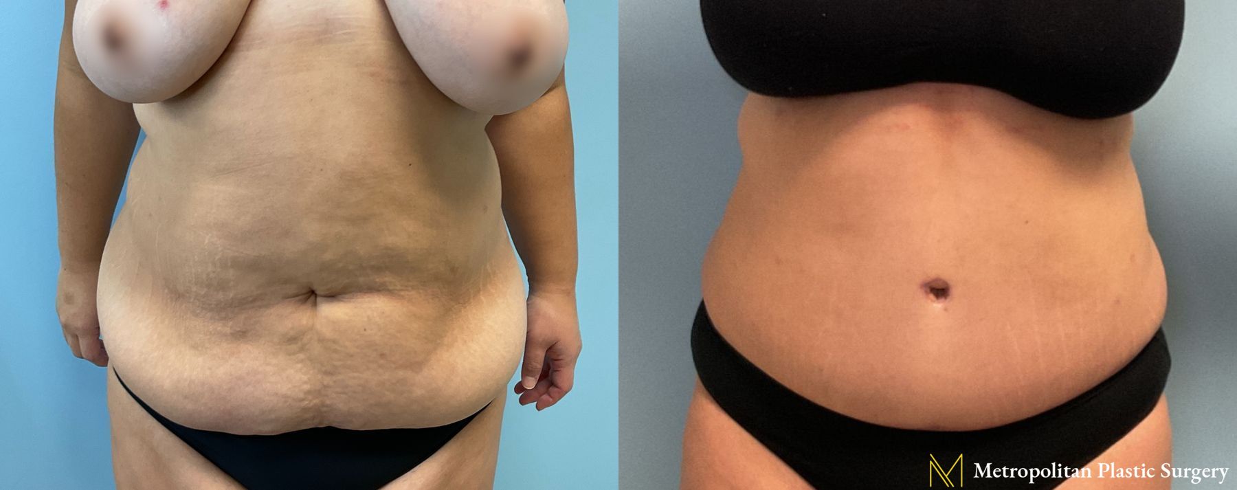Before and after Tummy Tuck case 26092