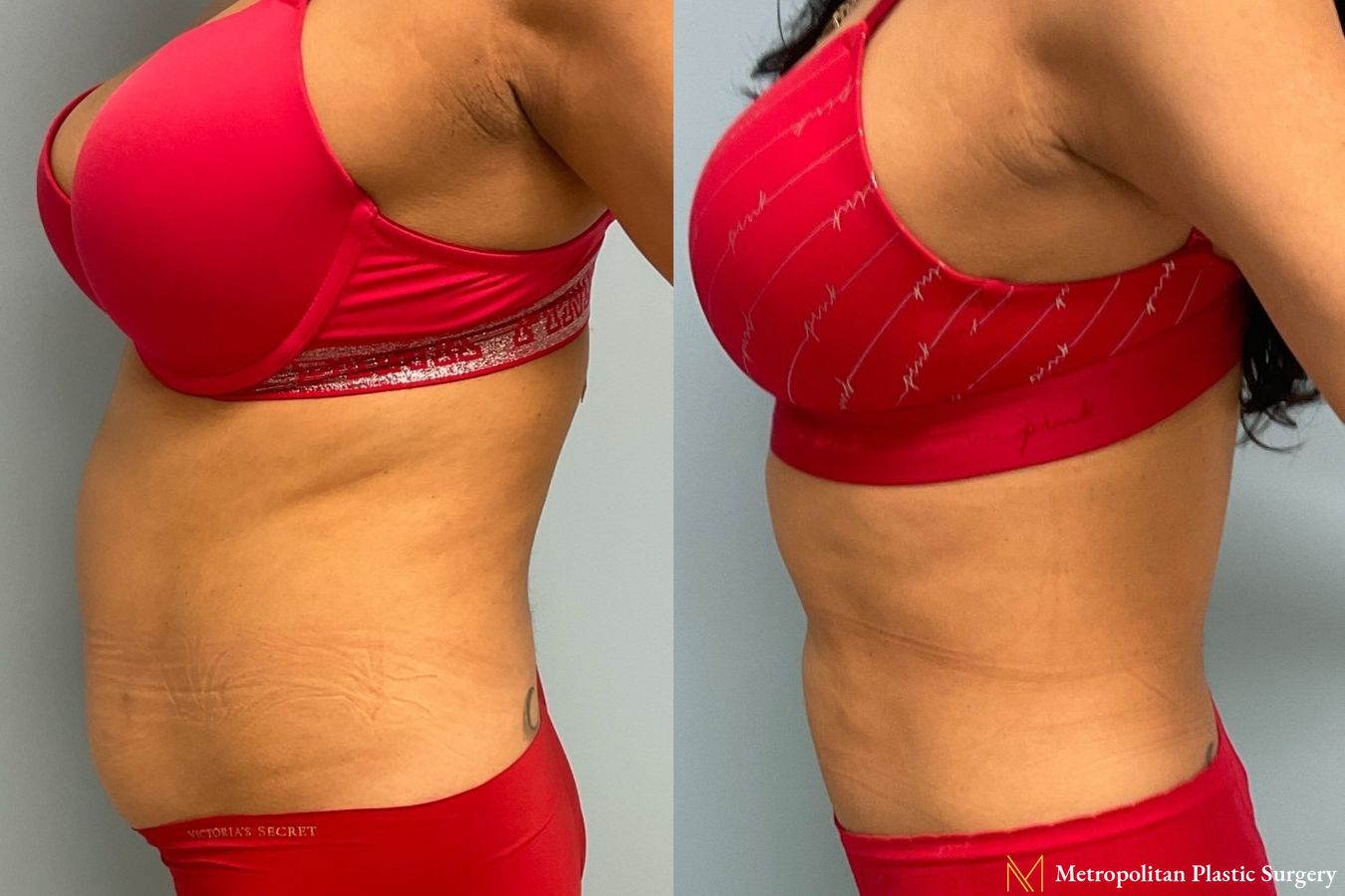 Let liposuction from board certified Julia Spears MD take care of stubborn fat. - Angle 4