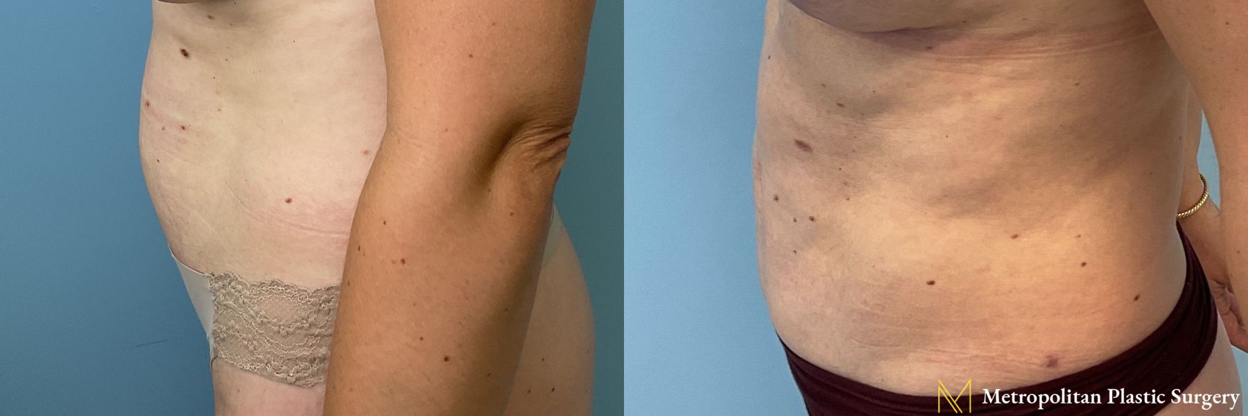 Before and after Liposuction case 41384 - Angle 3