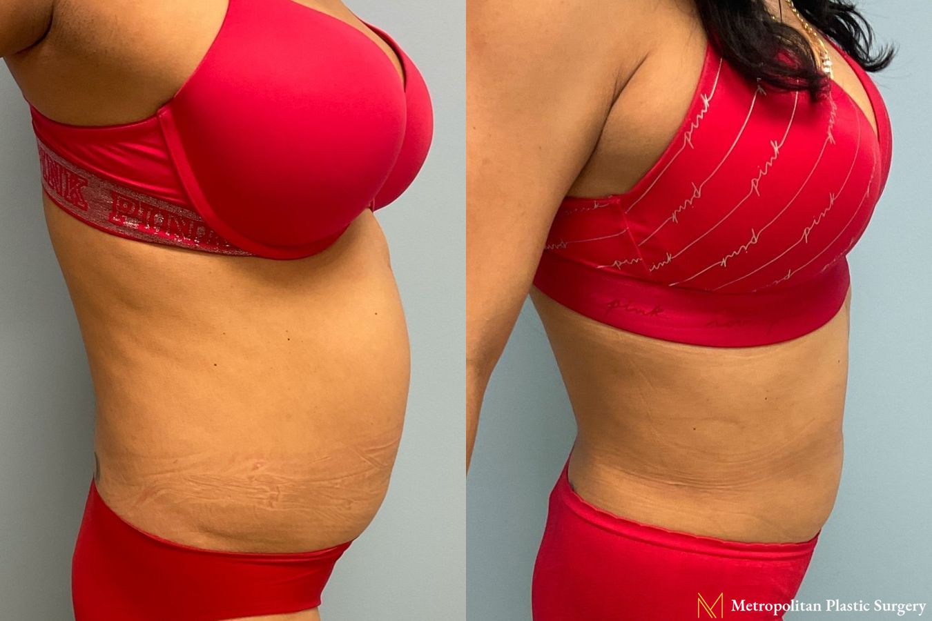 Let liposuction from board certified Julia Spears MD take care of stubborn fat. - Angle 2