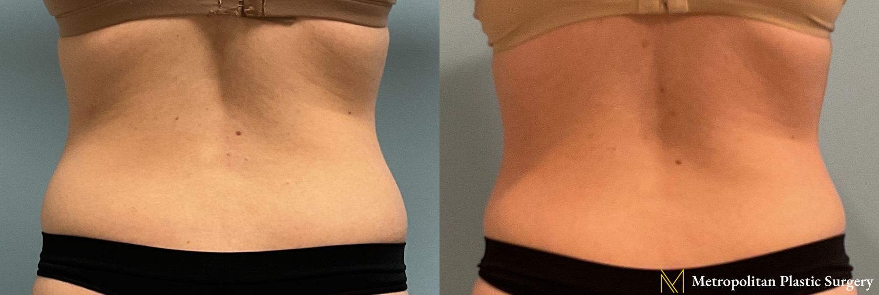 Before and after Liposuction case 23987 - Angle 2