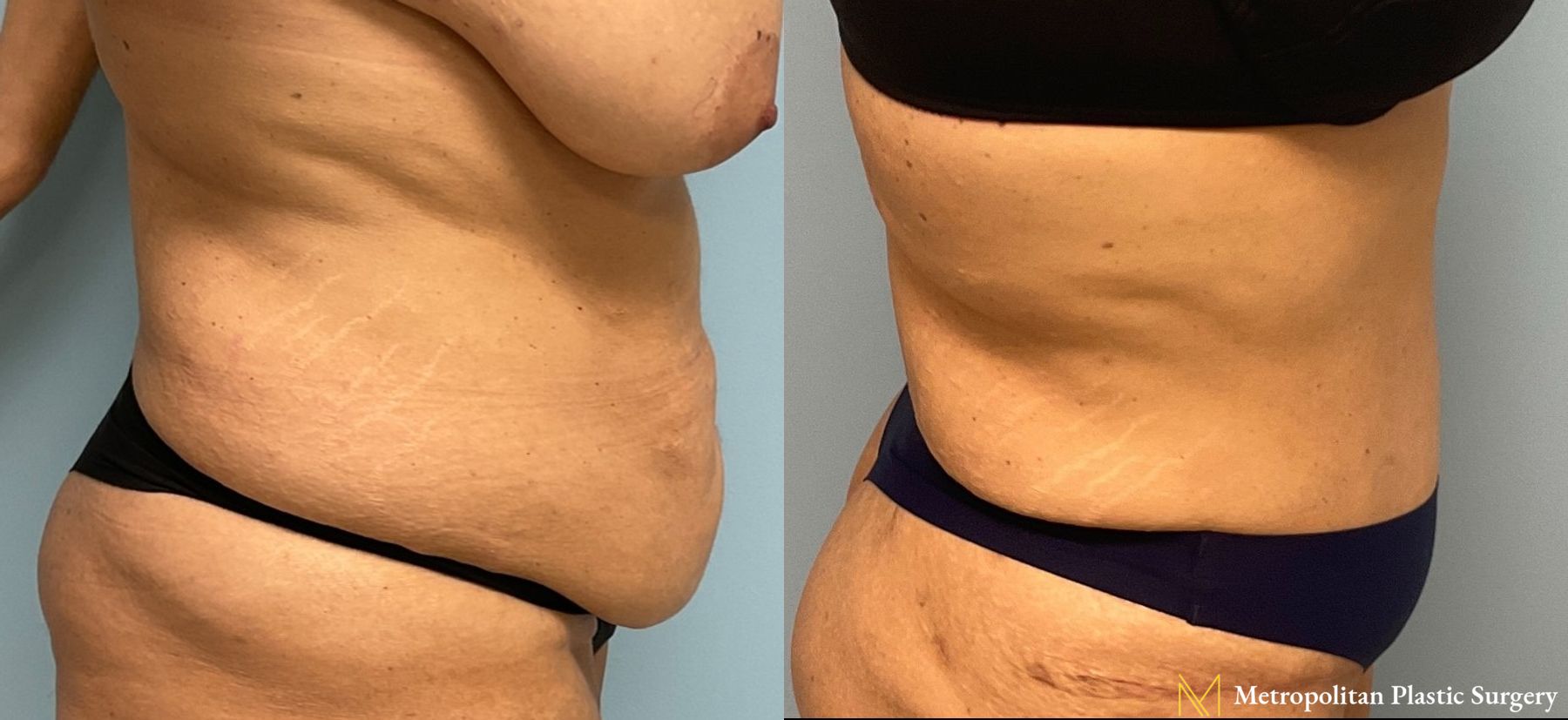 Let liposuction from board certified Julia Spears MD take care of stubborn fat. - Angle 2