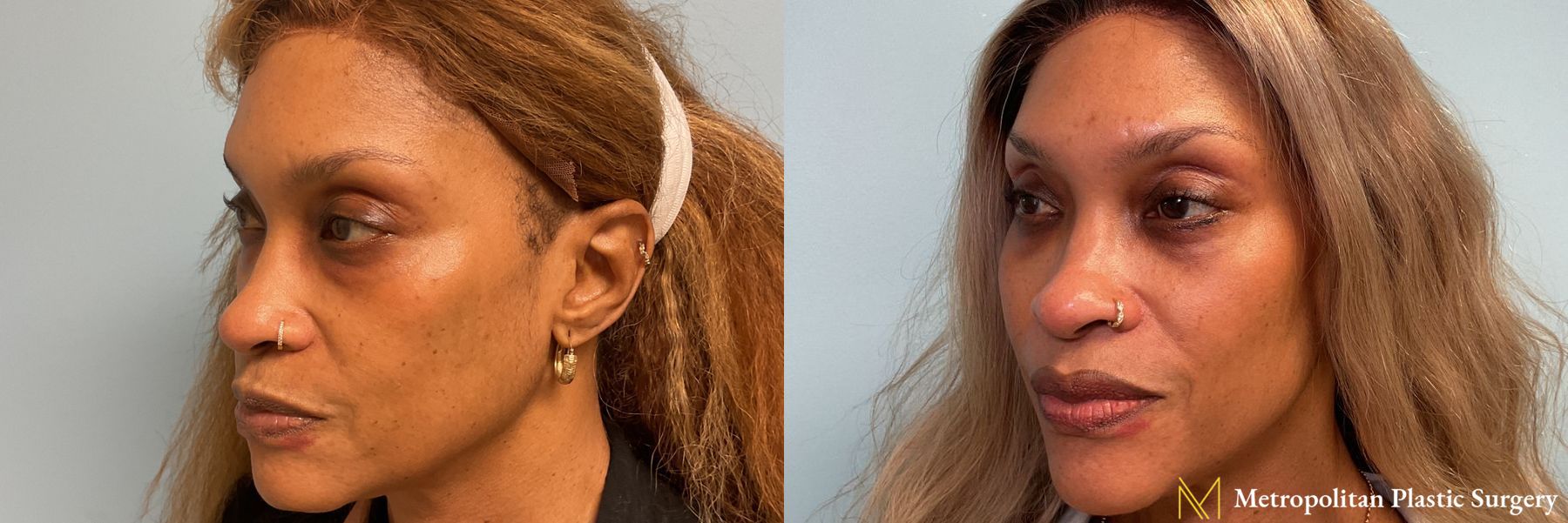 Lower Blepharoplasty performed by Dr. Julia Spears - Angle 2