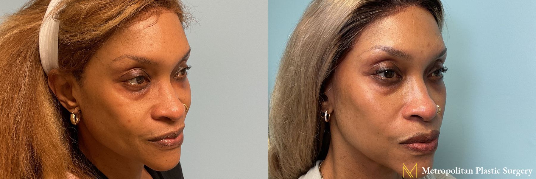 Lower Blepharoplasty performed by Dr. Julia Spears - Angle 3