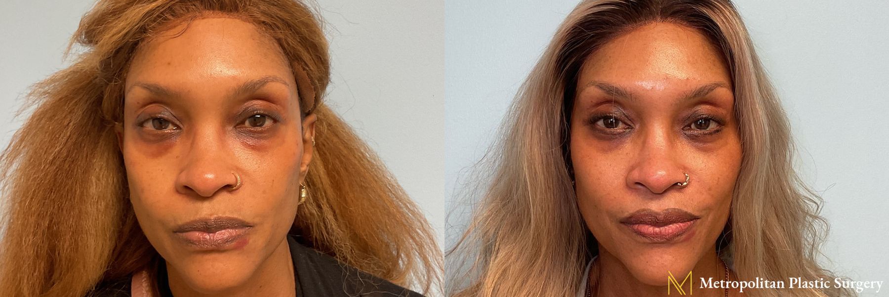 Lower Blepharoplasty performed by Dr. Julia Spears