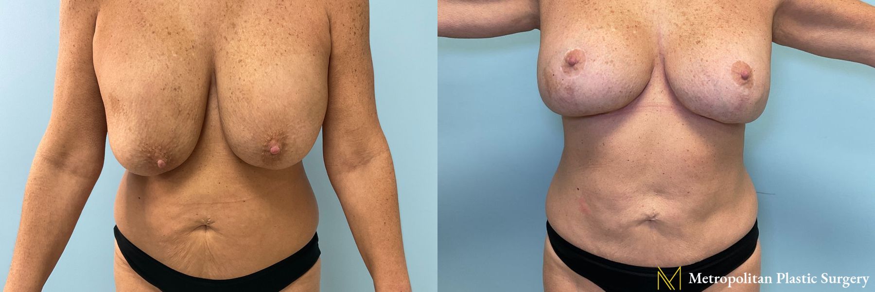 Before and after Tummy Tuck case 41771