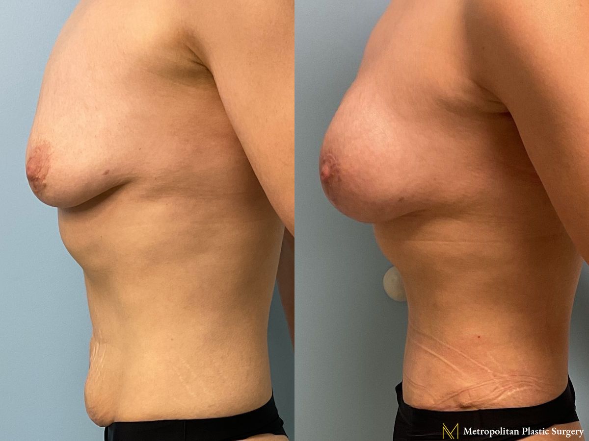 Mommy Makeover performed by Dr. Julia Spears - Angle 2