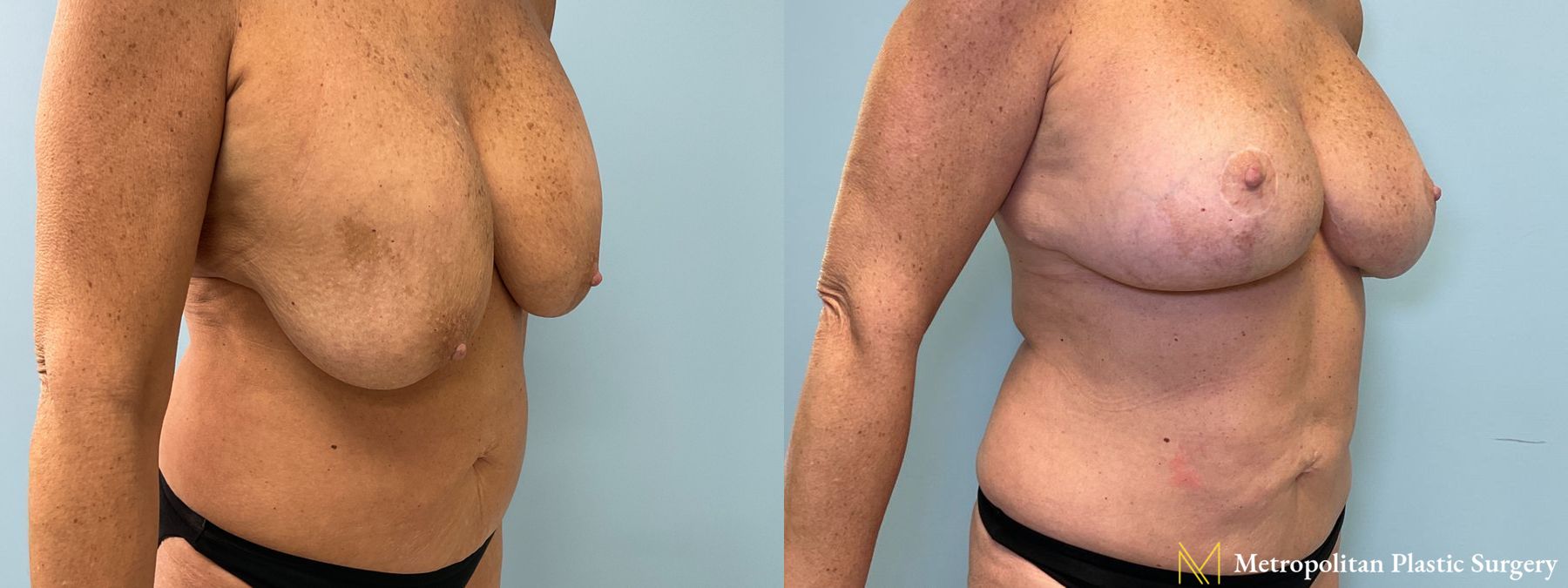 Before and after Tummy Tuck case 41771 - Angle 2