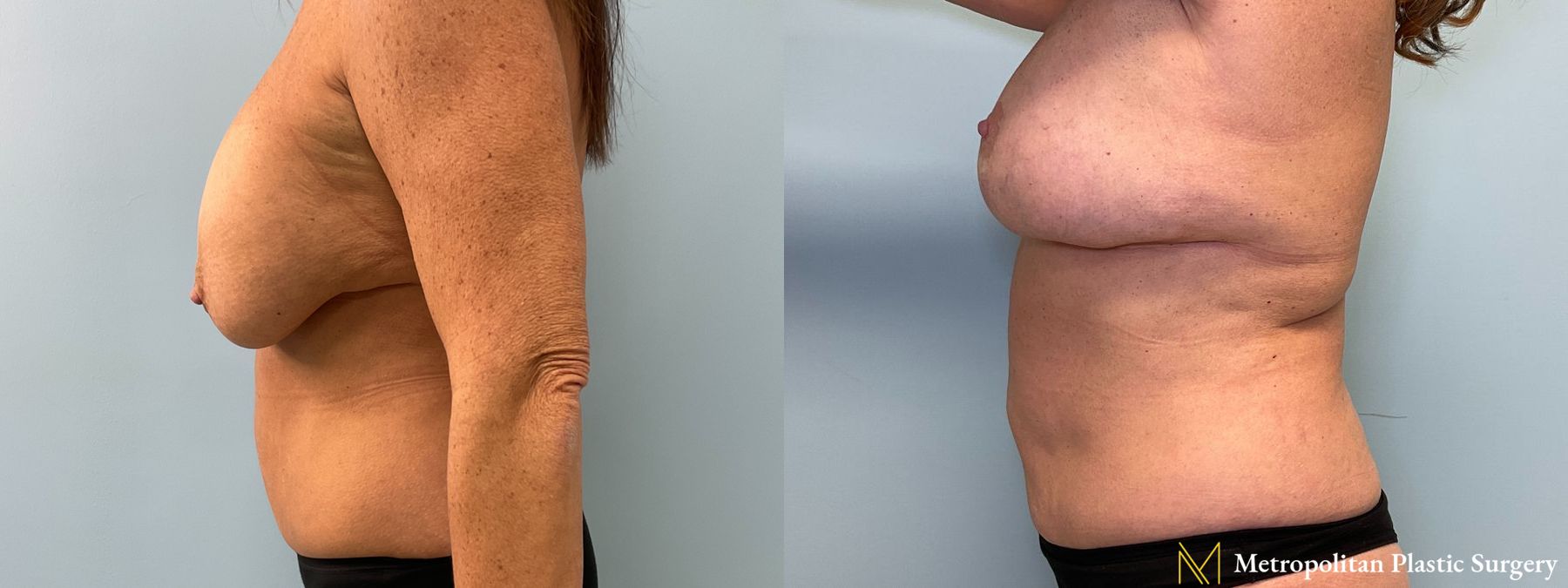 Before and after Tummy Tuck case 41771 - Angle 3