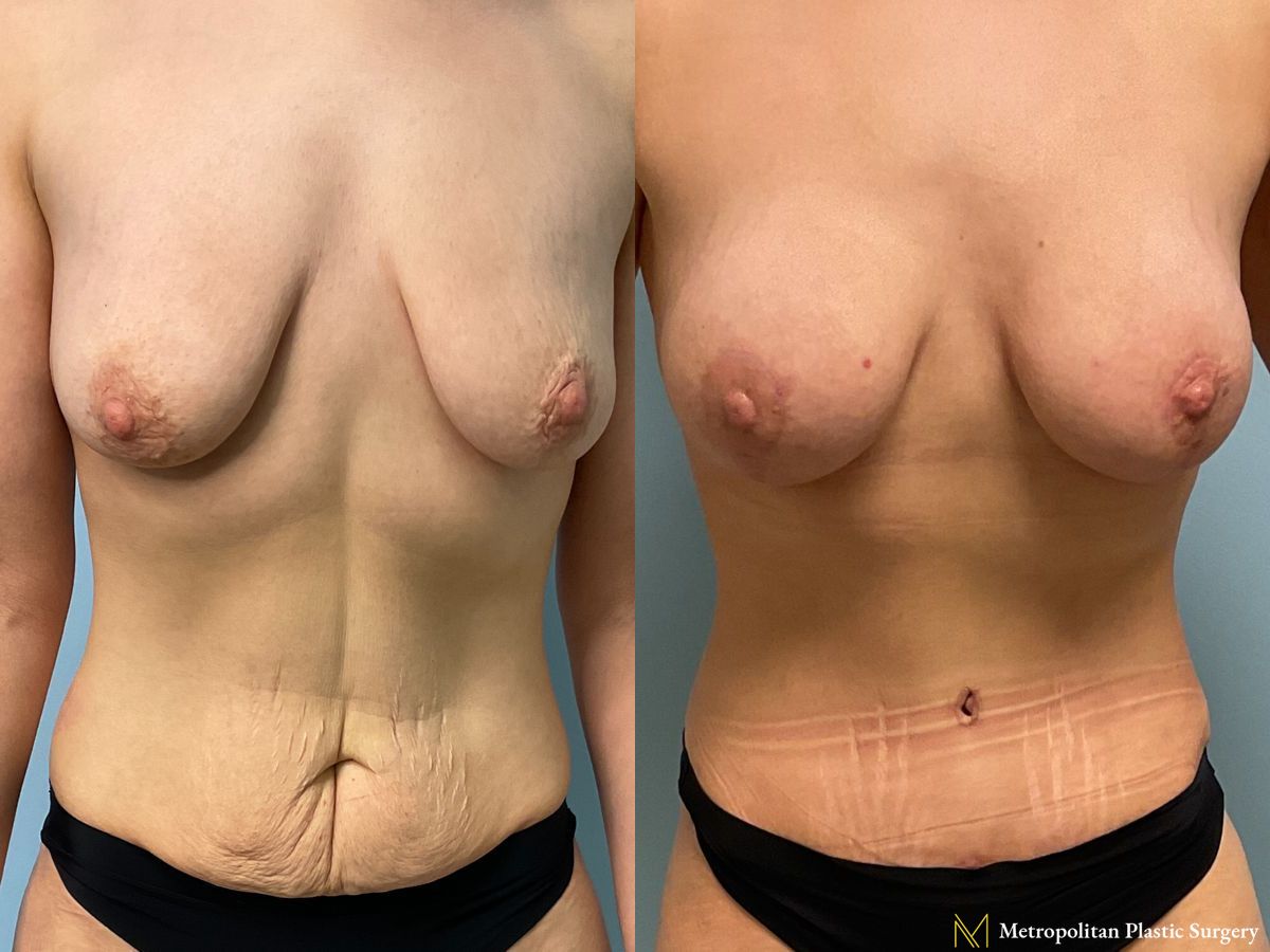 Mommy Makeover performed by Dr. Julia Spears