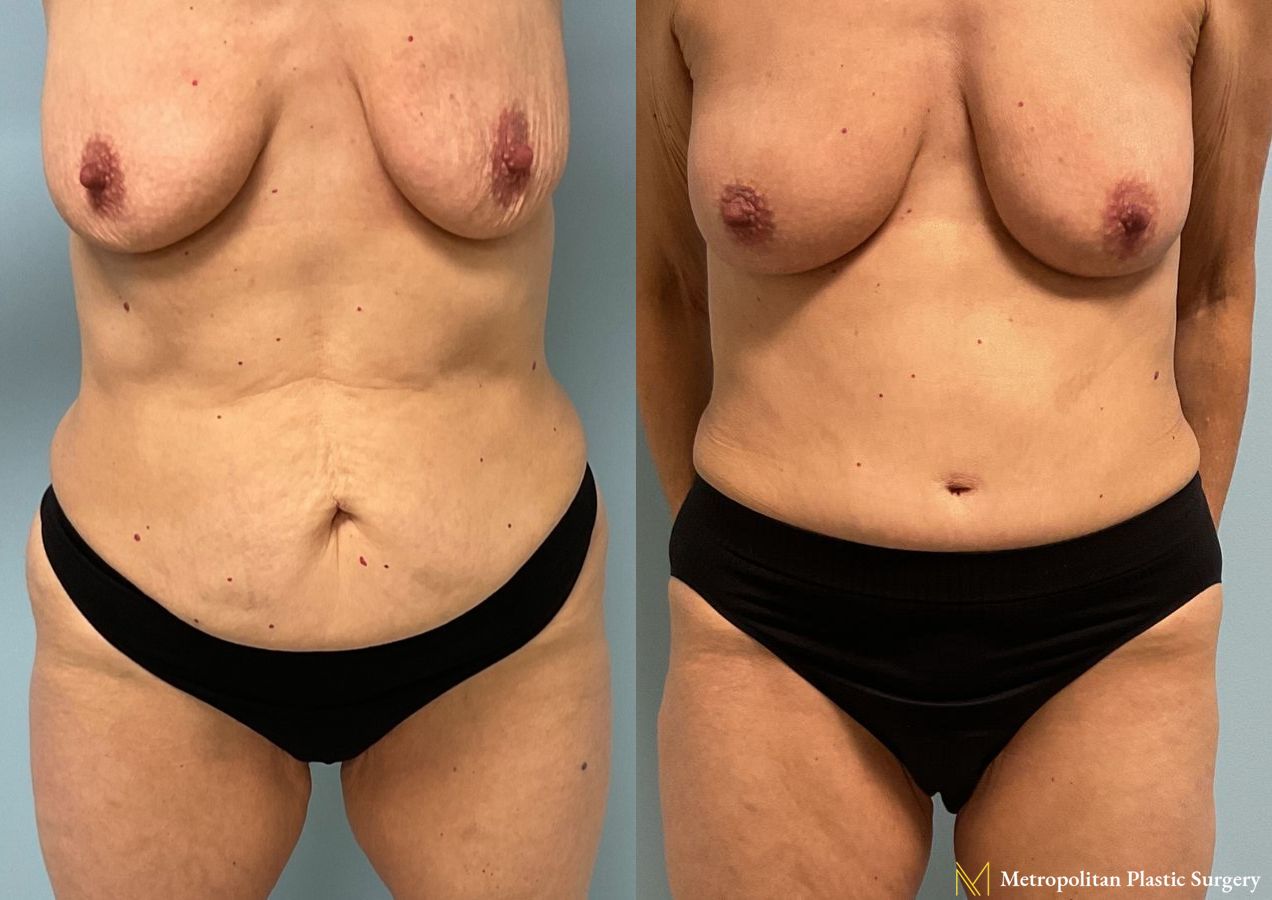 Mommy Makeover performed by Dr. Julia Spears