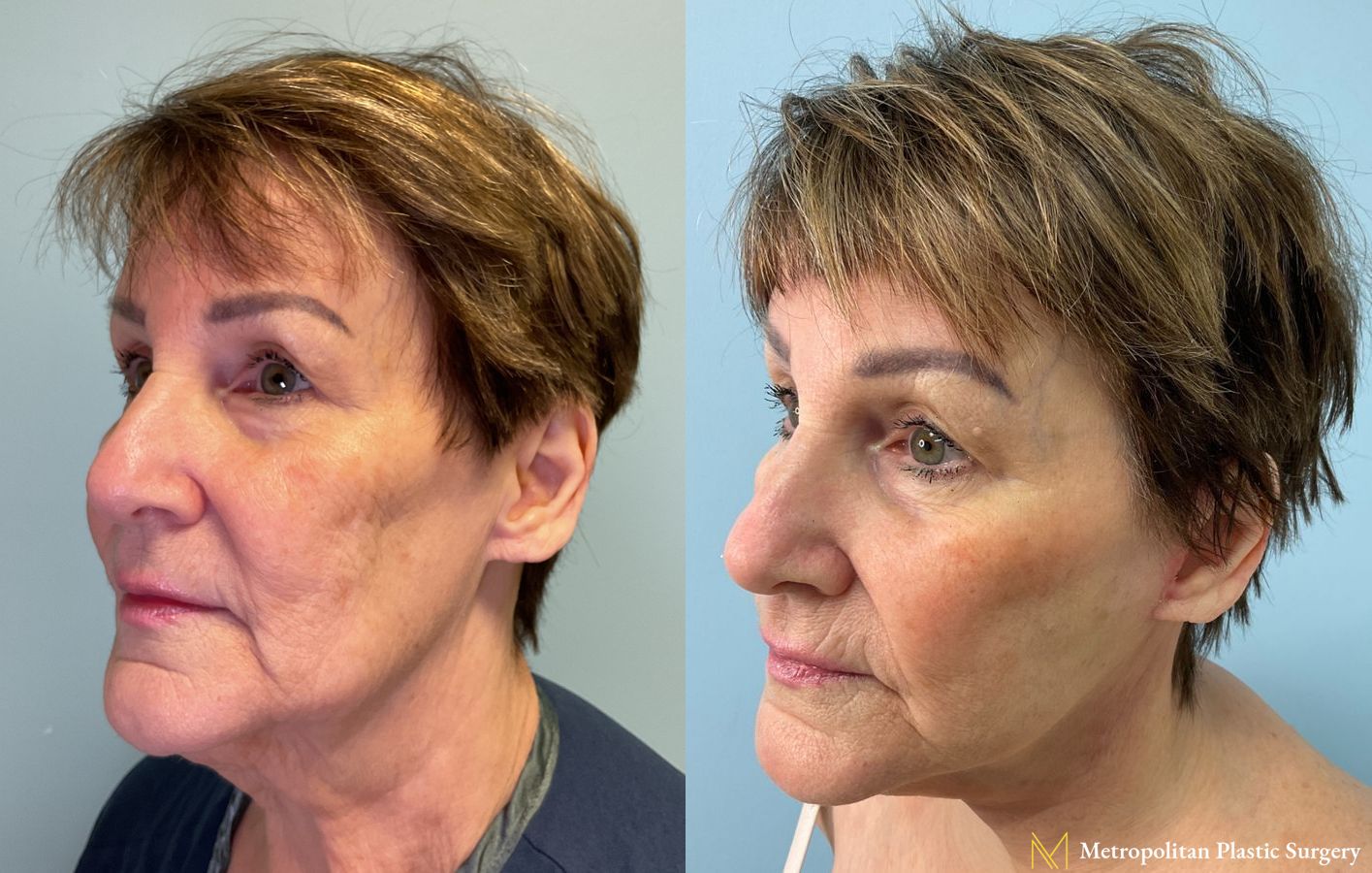 Before and after Facelift & Neck Lift case 23985 - Angle 2