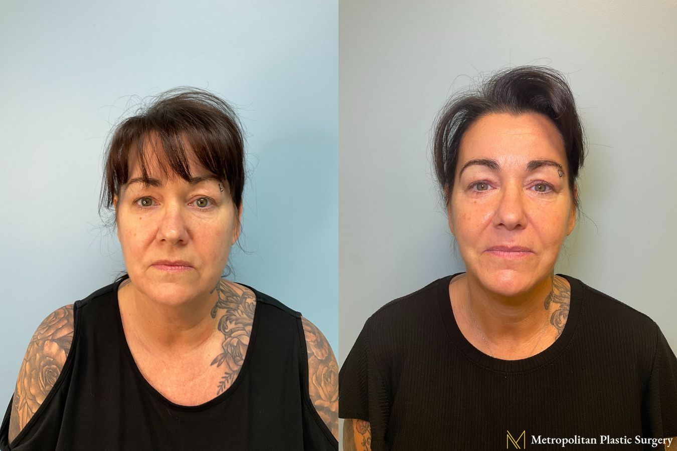 Before and after Facelift & Neck Lift case 8078