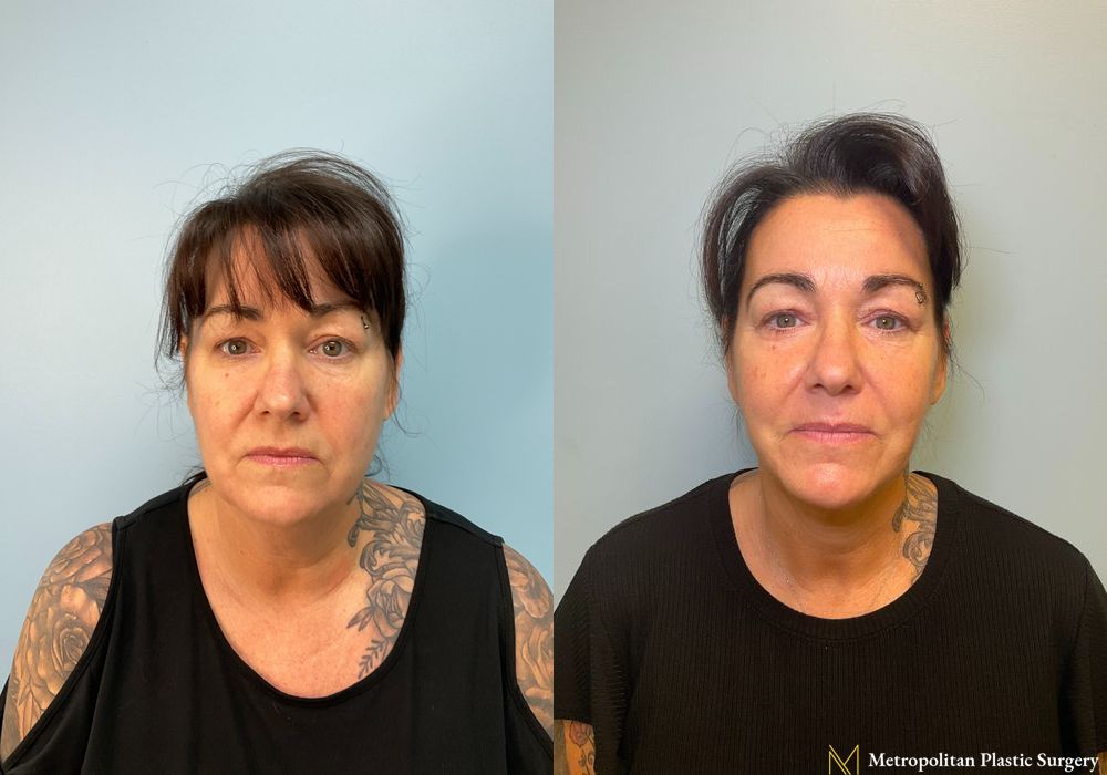 Neck Lift - Thumbnail 2