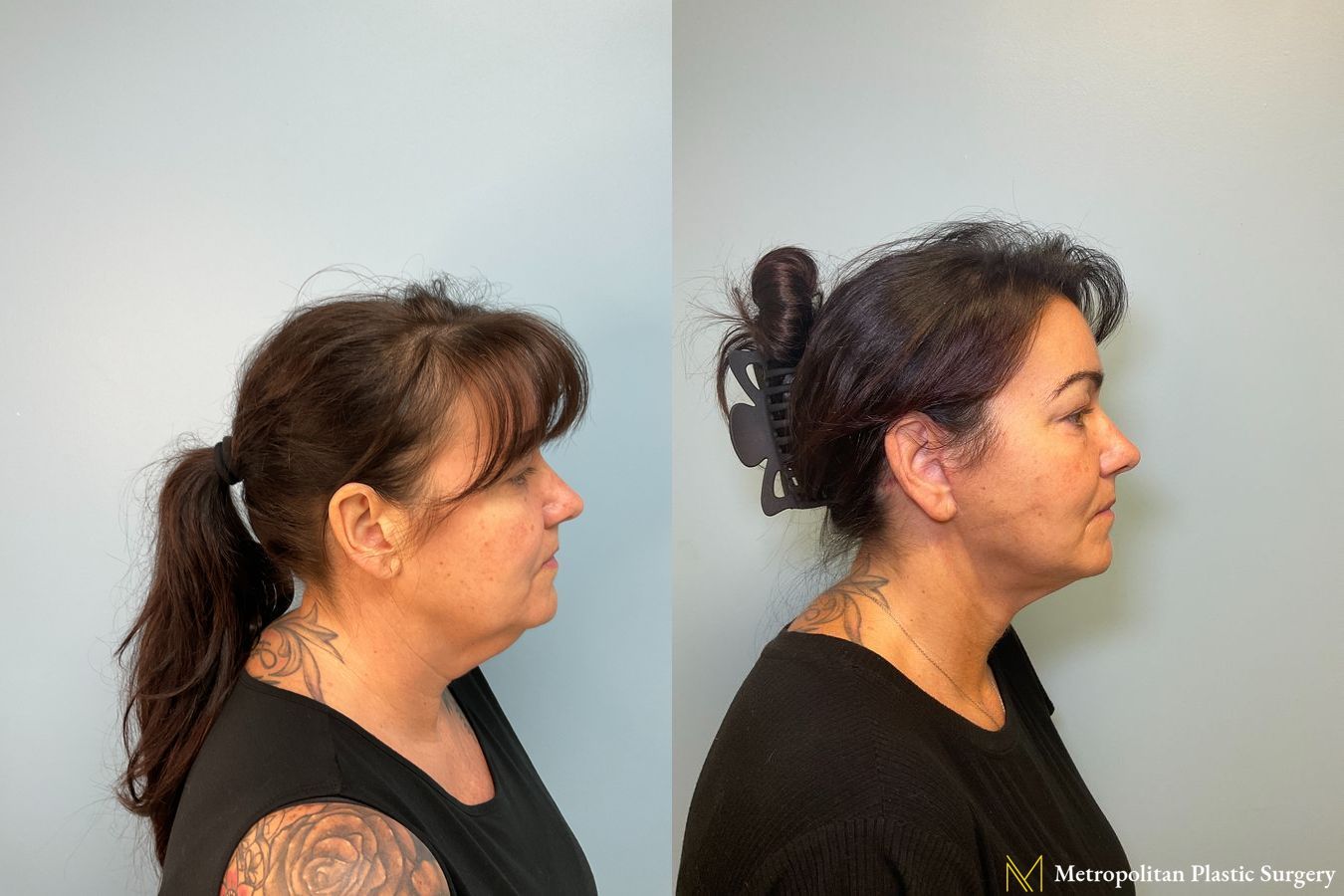 Before and after Facelift & Neck Lift case 8078 - Angle 2