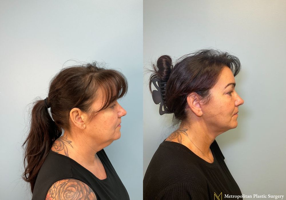 Neck Lift - Case 139